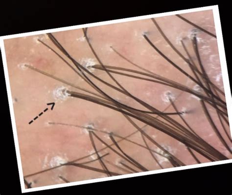 They develop when hair follicles (tiny holes in your skin) get clogged with dead skin cells and a protein called keratin. . Hair follicle white plug in hair morgellons disease